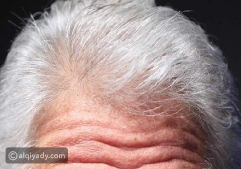 اكتشاف الجين المسؤول عن تحول لون الشعر للأبيض القيادي